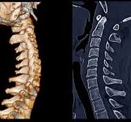 Capa educacional de TC cervical sem contraste — trauma e osso