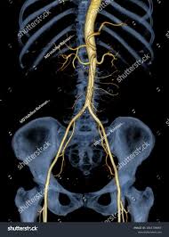 Capa educacional de Angio-TC da aorta abdominal