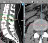 Capa educacional de TC de coluna lombar — anatomia óssea e MPR
